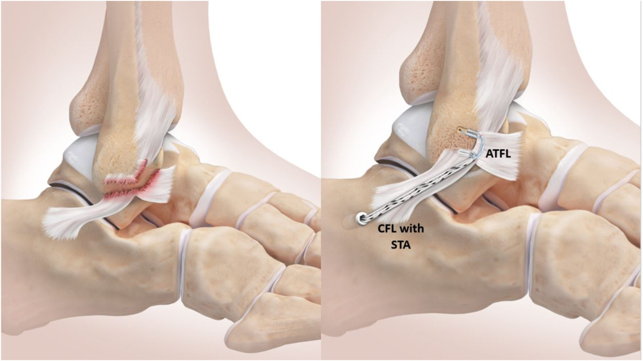 Ankle ligament – Modified Brostrom procedure/ Reconstruction – Jaysek ...